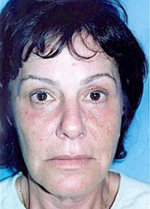 Eyelid Surgery Browlift Gallery - Patient 5883788 - Image 2