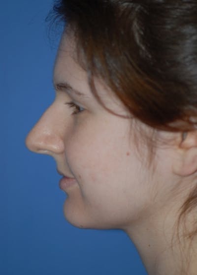 Rhinoplasty Before & After Gallery - Patient 5883790 - Image 1