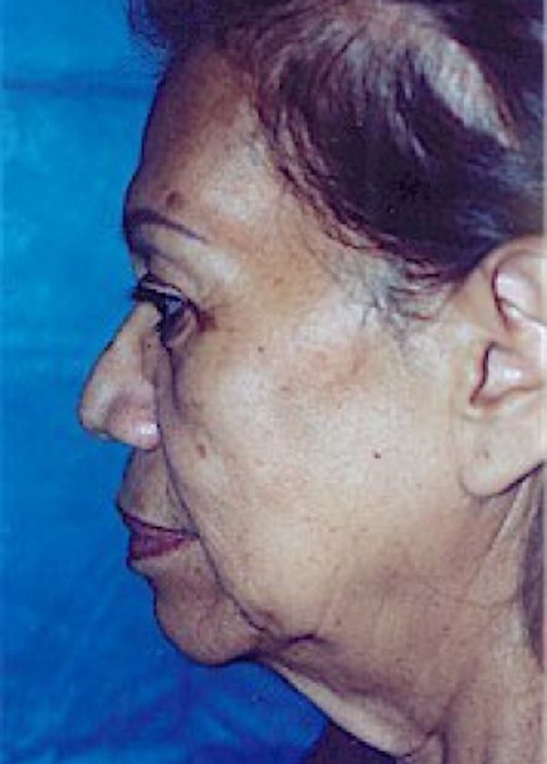 Facelift and Mini Facelift Before & After Gallery - Patient 5883791 - Image 3
