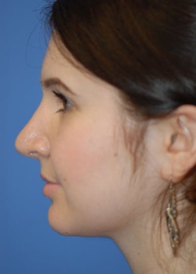 Rhinoplasty Before & After Gallery - Patient 5883790 - Image 2