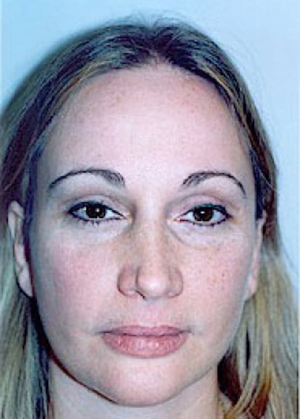 Eyelid Surgery Browlift Before & After Gallery - Patient 5883792 - Image 2