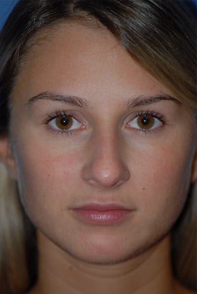Rhinoplasty Before & After Gallery - Patient 5883802 - Image 1