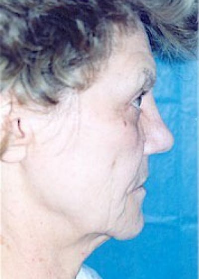 Facelift and Mini Facelift Before & After Gallery - Patient 5883796 - Image 1
