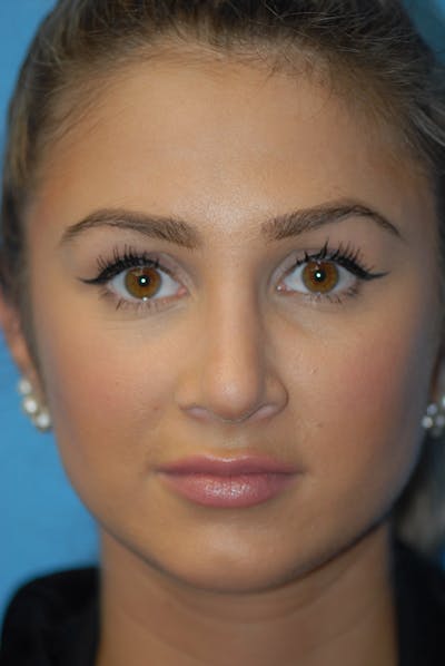 Rhinoplasty Before & After Gallery - Patient 5883802 - Image 2