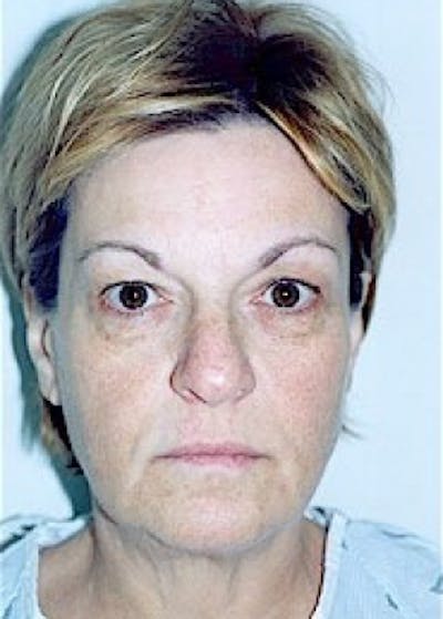 Eyelid Surgery Browlift Before & After Gallery - Patient 5883797 - Image 1