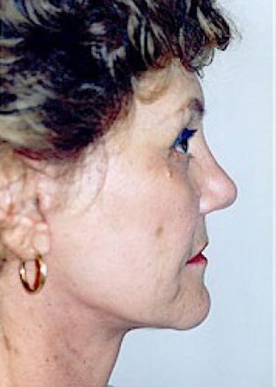 Facelift and Mini Facelift Before & After Gallery - Patient 5883796 - Image 2