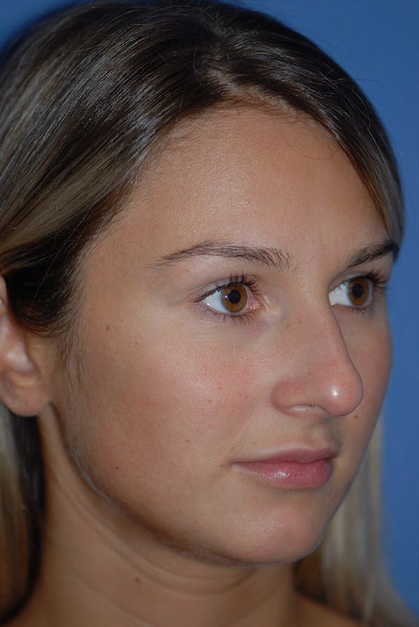 Rhinoplasty Before & After Gallery - Patient 5883802 - Image 3