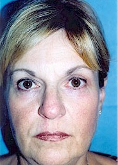 Eyelid Surgery Browlift Before & After Gallery - Patient 5883797 - Image 2