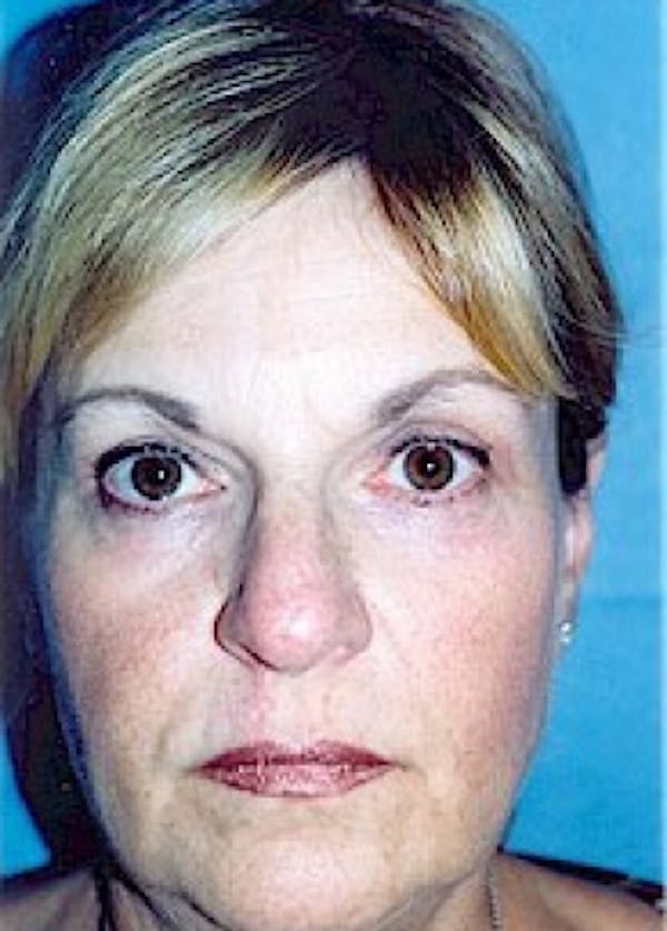 Eyelid Surgery Browlift Before & After Gallery - Patient 5883797 - Image 2