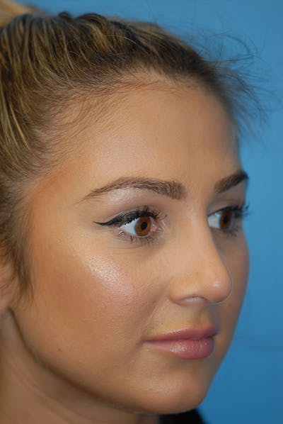 Rhinoplasty Before & After Gallery - Patient 5883802 - Image 4