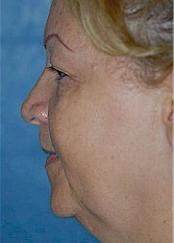 Facelift and Mini Facelift Gallery - Patient 5883805 - Image 1
