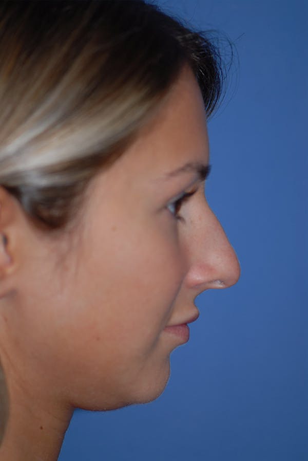 Rhinoplasty Before & After Gallery - Patient 5883802 - Image 5