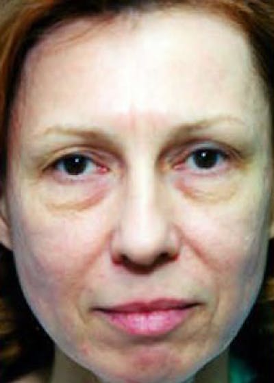 Eyelid Surgery Browlift Before & After Gallery - Patient 5883798 - Image 1