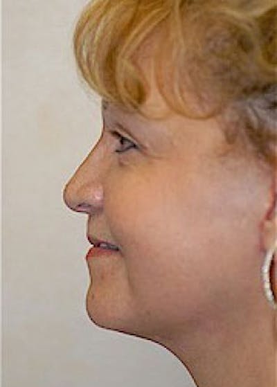 Facelift and Mini Facelift Before & After Gallery - Patient 5883805 - Image 2