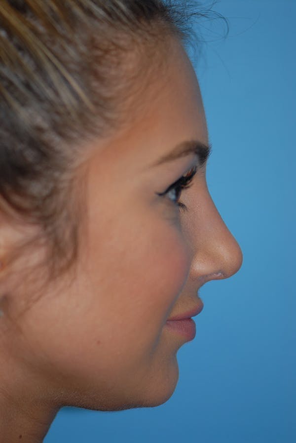 Rhinoplasty Before & After Gallery - Patient 5883802 - Image 6