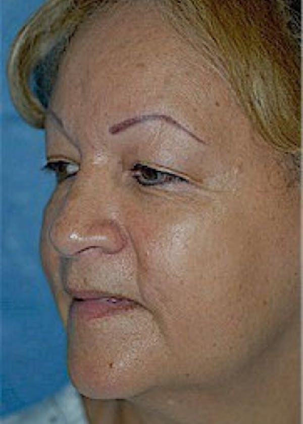 Facelift and Mini Facelift Before & After Gallery - Patient 5883805 - Image 3