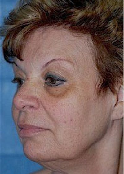 Facelift and Mini Facelift Before & After Gallery - Patient 5883808 - Image 1
