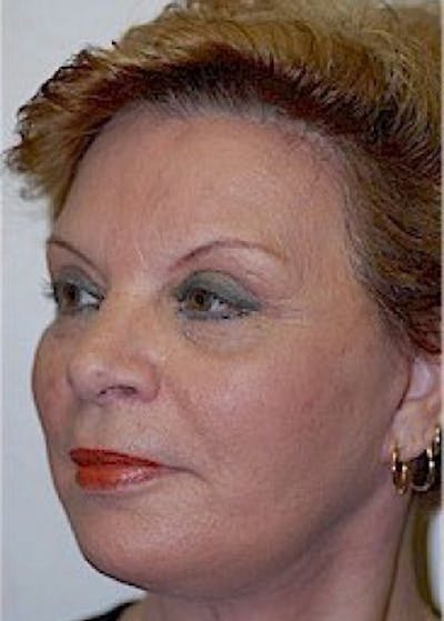 Facelift and Mini Facelift Gallery - Patient 5883808 - Image 2