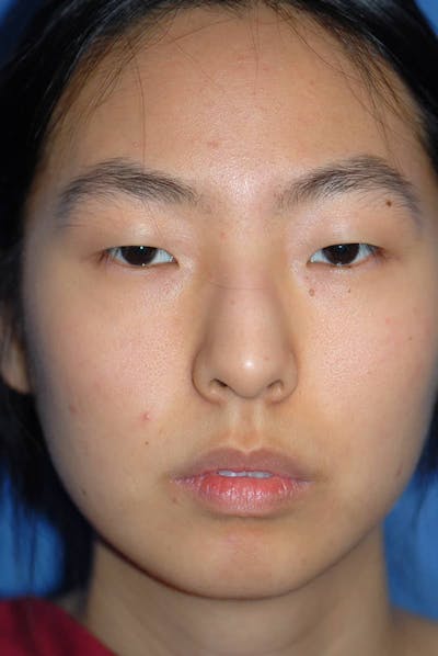 Rhinoplasty Before & After Gallery - Patient 5883817 - Image 1