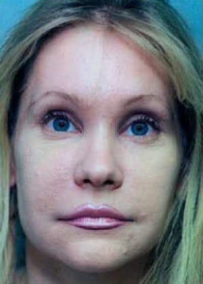 Eyelid Surgery Browlift Before & After Gallery - Patient 5883811 - Image 2