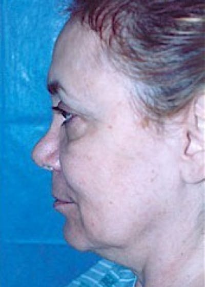 Facelift and Mini Facelift Before & After Gallery - Patient 5883814 - Image 1
