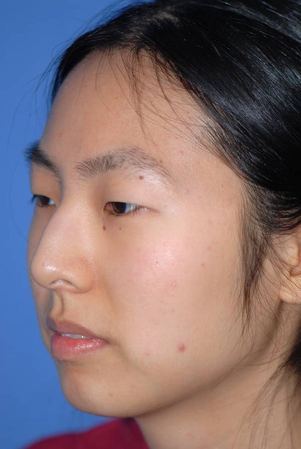 Rhinoplasty Before & After Gallery - Patient 5883817 - Image 3