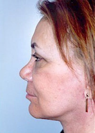 Facelift and Mini Facelift Gallery - Patient 5883814 - Image 2