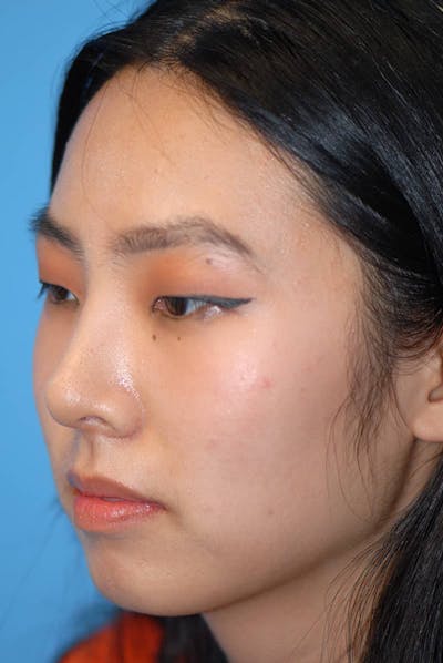 Rhinoplasty Before & After Gallery - Patient 5883817 - Image 4