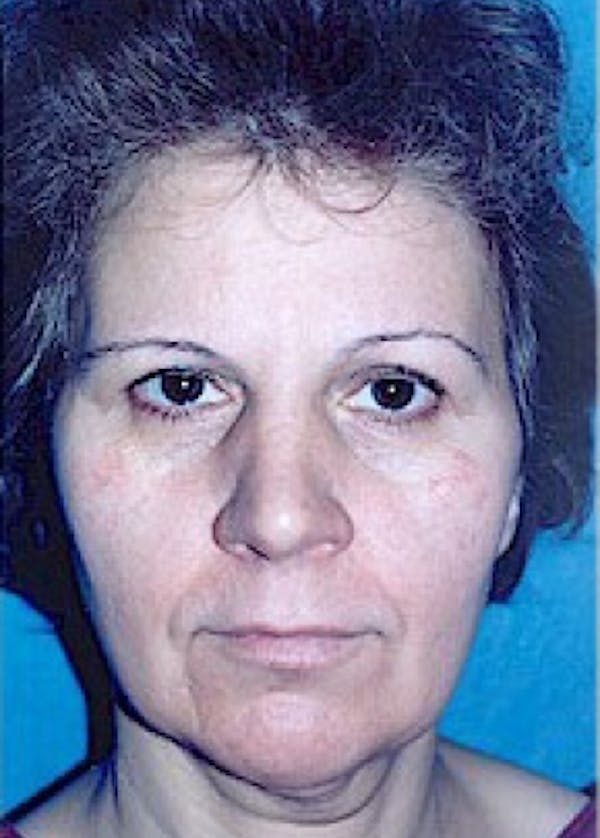 Facelift and Mini Facelift Gallery - Patient 5883821 - Image 1