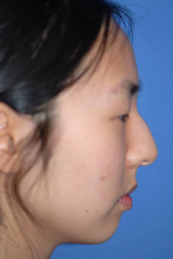 Rhinoplasty Before & After Gallery - Patient 5883817 - Image 5