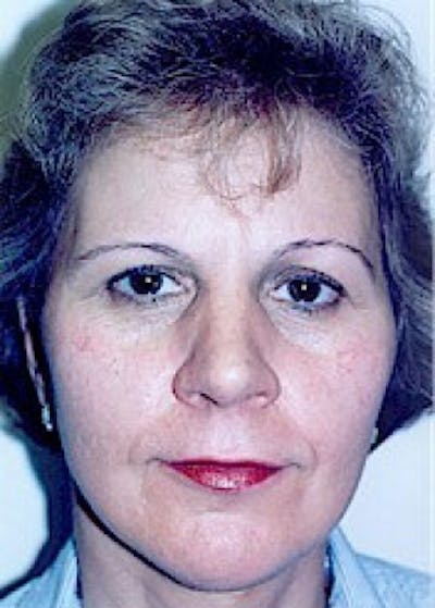 Facelift and Mini Facelift Before & After Gallery - Patient 5883821 - Image 2
