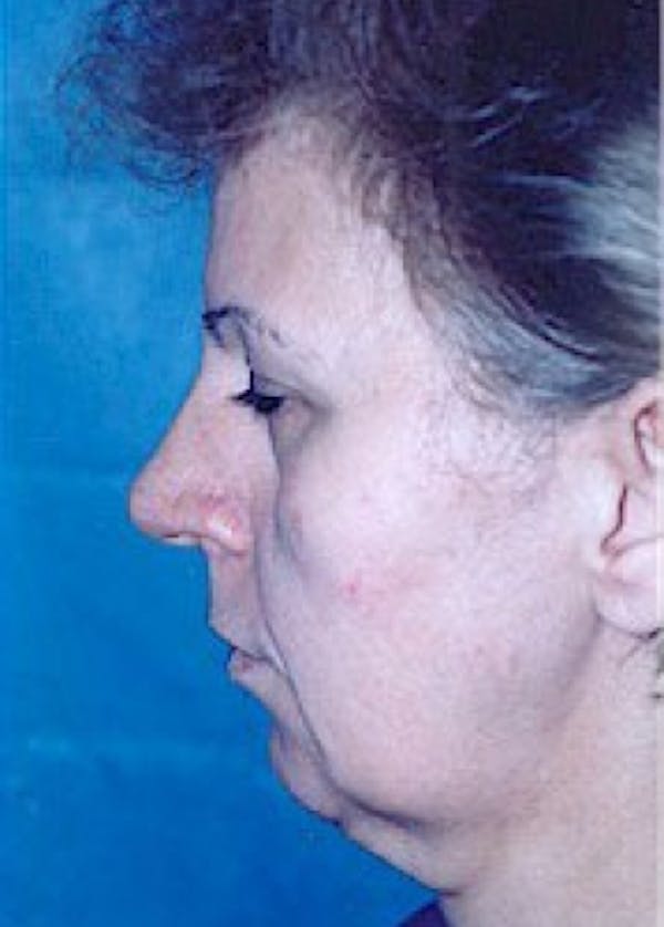 Facelift and Mini Facelift Before & After Gallery - Patient 5883821 - Image 3