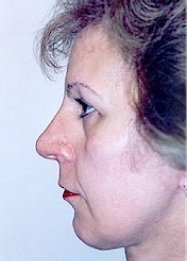 Facelift and Mini Facelift Gallery - Patient 5883821 - Image 4