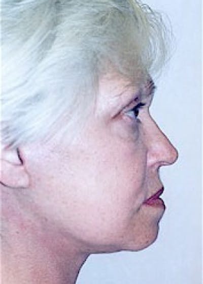 Facelift and Mini Facelift Before & After Gallery - Patient 5883825 - Image 2