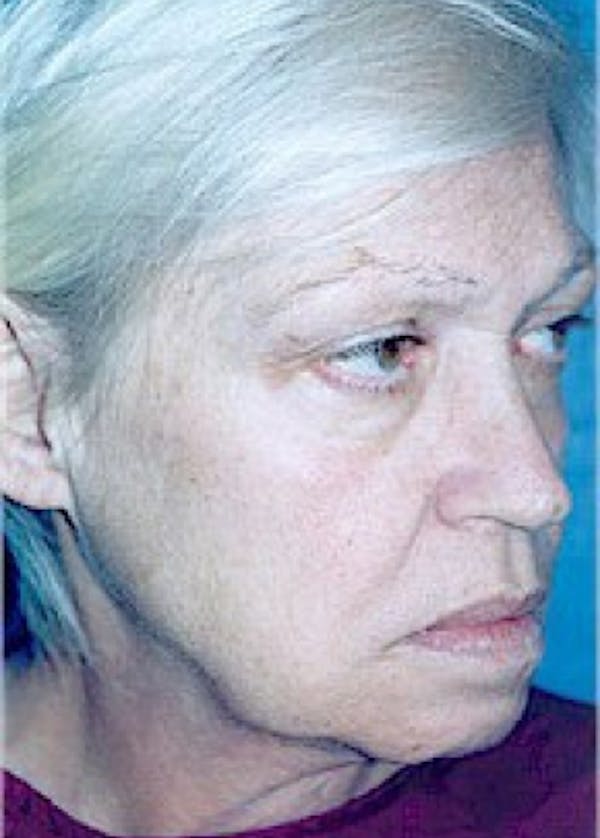 Facelift and Mini Facelift Before & After Gallery - Patient 5883825 - Image 3
