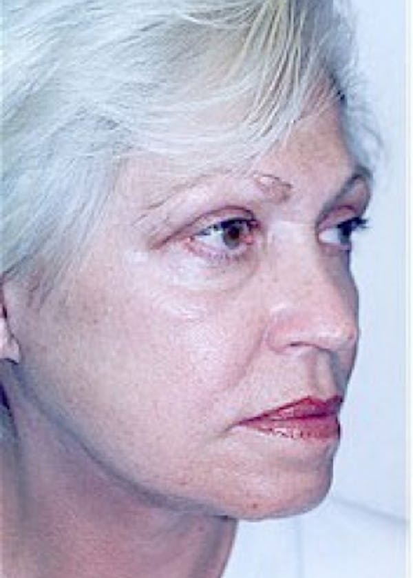 Facelift and Mini Facelift Before & After Gallery - Patient 5883825 - Image 4