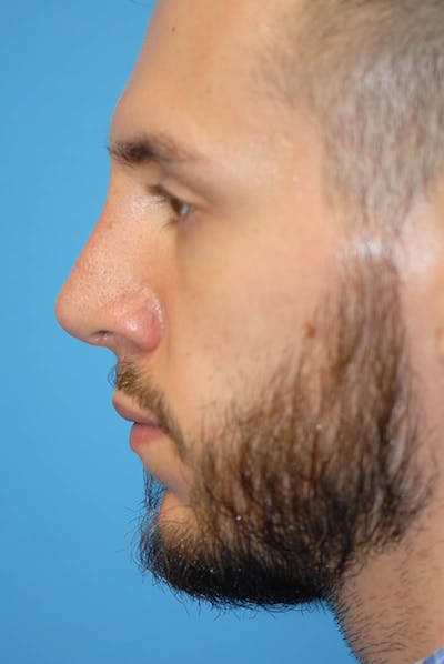 Rhinoplasty Before & After Gallery - Patient 5883826 - Image 2