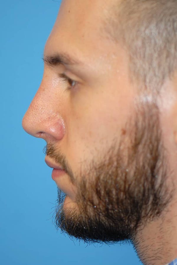 Rhinoplasty Before & After Gallery - Patient 5883826 - Image 2