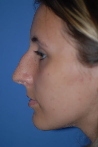 Rhinoplasty Before & After Gallery - Patient 5883835 - Image 1