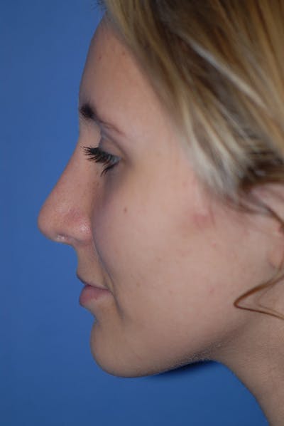 Rhinoplasty Before & After Gallery - Patient 5883835 - Image 2
