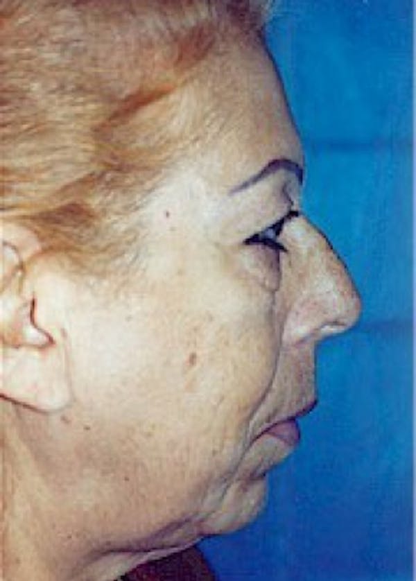 Facelift and Mini Facelift Before & After Gallery - Patient 5883830 - Image 3