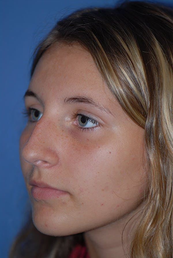 Rhinoplasty Before & After Gallery - Patient 5883835 - Image 3