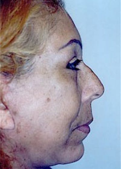 Facelift and Mini Facelift Before & After Gallery - Patient 5883830 - Image 4