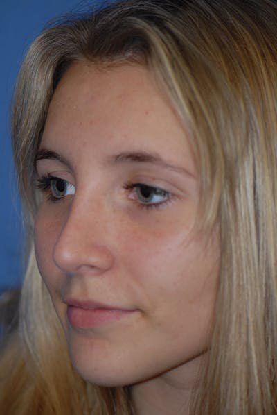Rhinoplasty Before & After Gallery - Patient 5883835 - Image 4