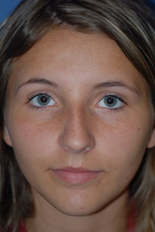 Rhinoplasty Before & After Gallery - Patient 5883835 - Image 5