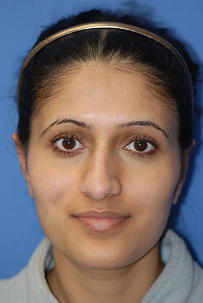 Otoplasty Before & After Gallery - Patient 5883832 - Image 2