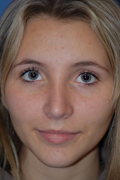 Rhinoplasty Before & After Gallery - Patient 5883835 - Image 6