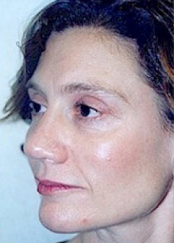 Cheeklift Threadlift Before & After Gallery - Patient 5883833 - Image 2