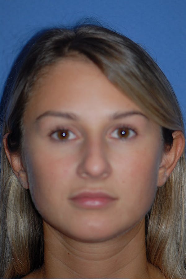 Otoplasty Before & After Gallery - Patient 5883834 - Image 1