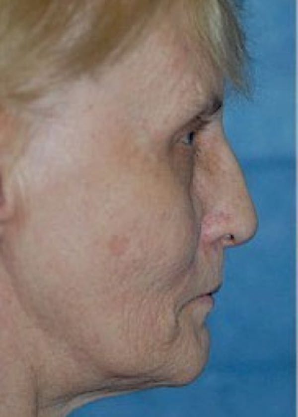 Facelift and Mini Facelift Before & After Gallery - Patient 5883836 - Image 3